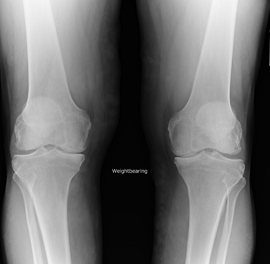 X-Ray - My damaged both knees